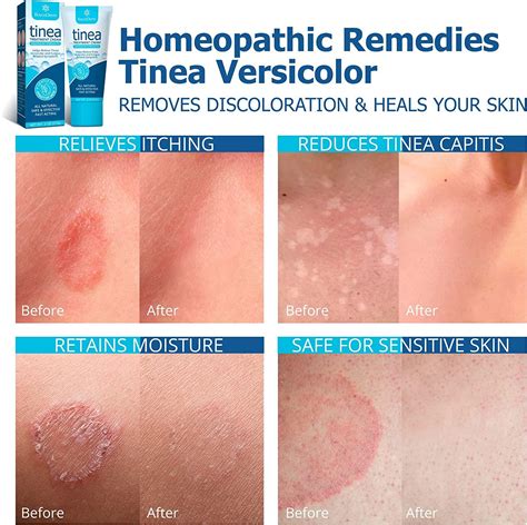 Ringworm Treatment
