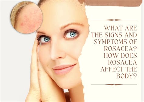 Rosacea Symptoms