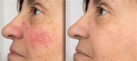 Rosacea Treatment