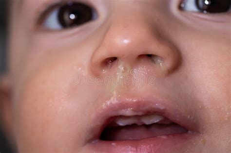 Runny Nose and Congestion