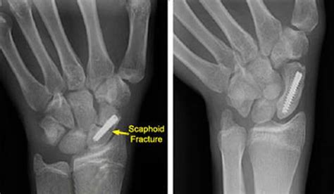Scaphoid bone fracture X-ray
