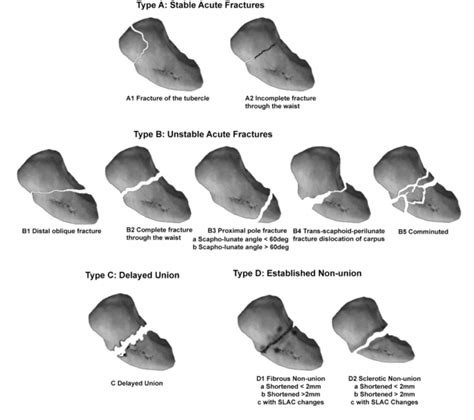 Scaphoid bone fracture types illustration
