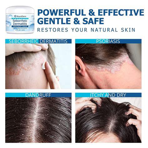 Seborrheic Dermatitis Treatment