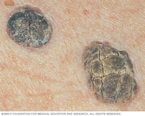 Seborrheic Keratoses Causes