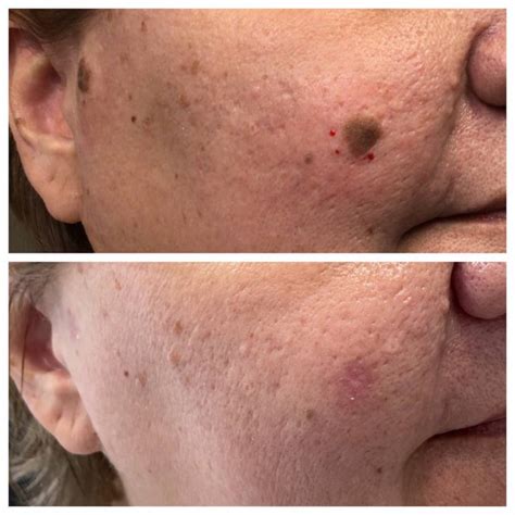 Seborrheic Keratoses Removal