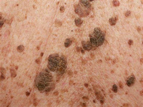Seborrheic Keratoses Symptoms Photos