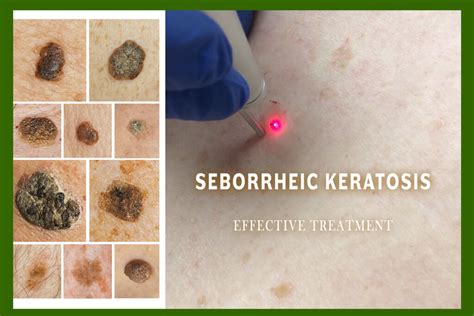Seborrheic Keratoses Treatment
