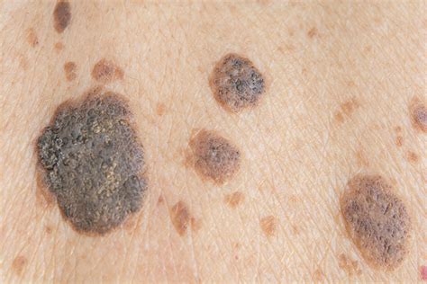 Seborrheic Keratosis Images