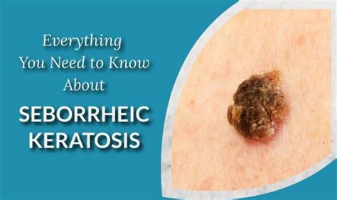 Seborrheic Keratosis Prevention