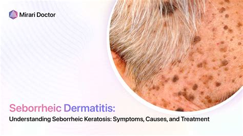 Seborrheic Keratosis Symptoms