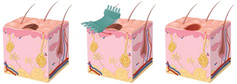 Shave Excision