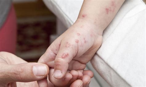 shingles in children