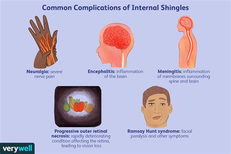 Shingles complications