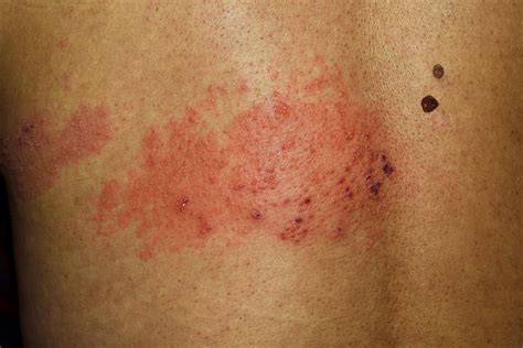 Shingles rash