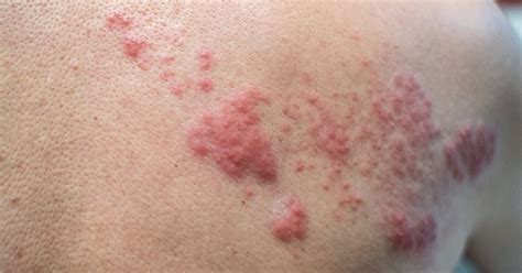 shingles social isolation