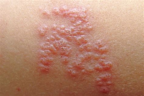 Shingles treatment