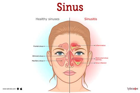 Sinusitis