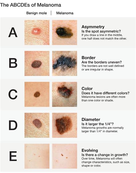 Skin Cancer Screening and Treatment