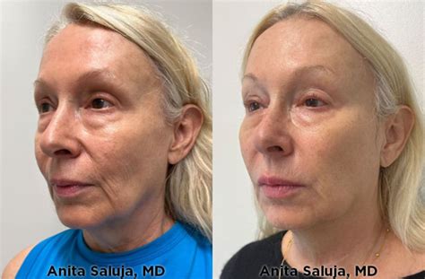 Skin Cancer Treatment
