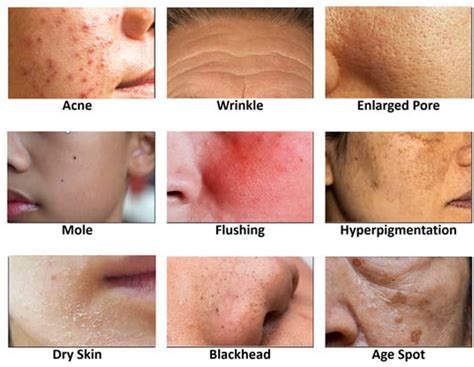 Skin conditions