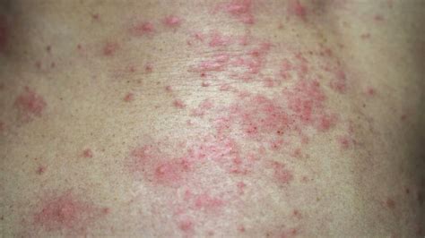 Skin Rashes