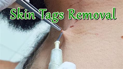 Skin tag removal techniques