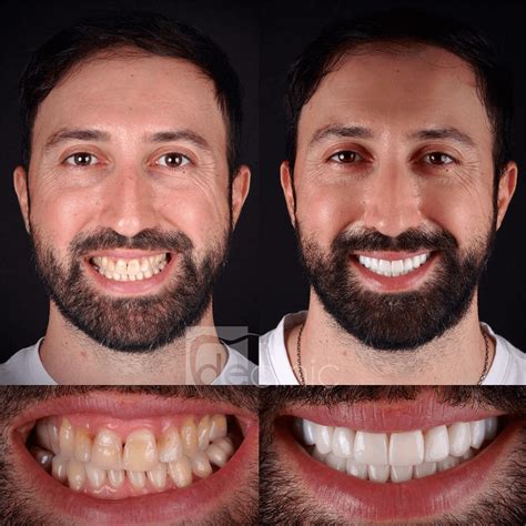 Smile Makeover at West Seattle Dental Center