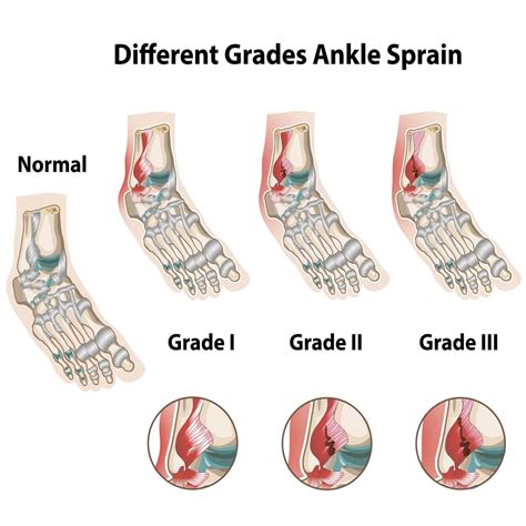 Sprained Ankle Physiotherapy Stages