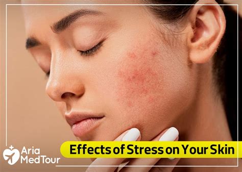 Stress management for healthy skin