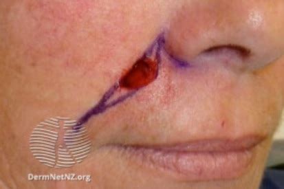 Surgical Excision for Skin Cancer