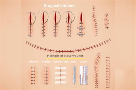 Suture Removal at Home