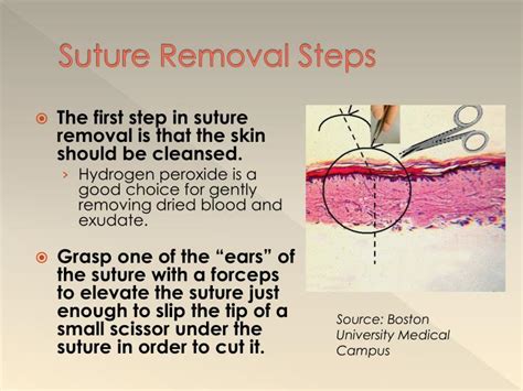 Step-by-step guide to removing sutures
