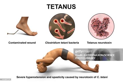 Tetanus infection