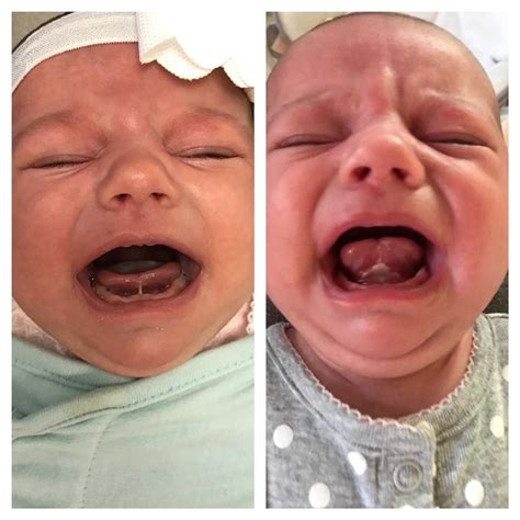 Tied Tongue in Newborns