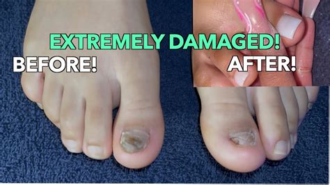 Causes of a Ripped Off Toenail