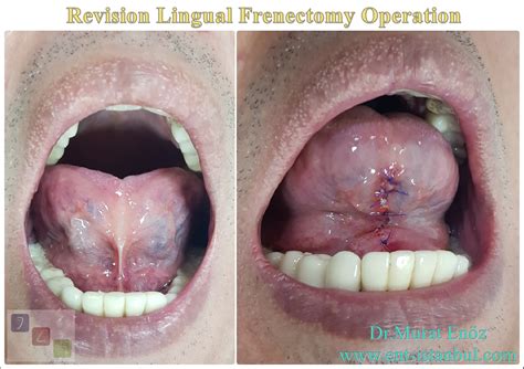 Tongue Frenectomy