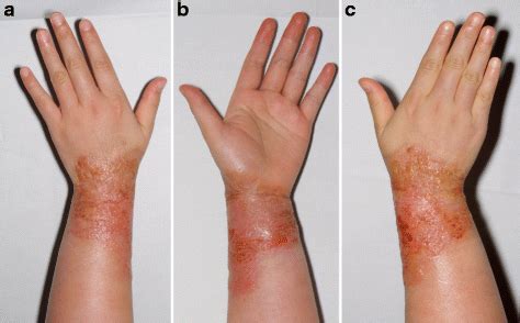 Topical Cream for Chemical Burns