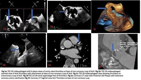 Transesophageal Echocardiogram TEE Conclusion