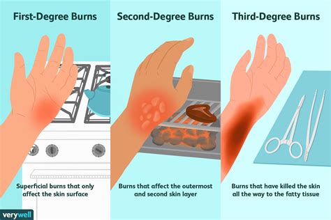 Treatment for 2nd degree burns