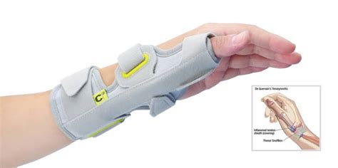 Treatment options for De Quervain's tenosynovitis