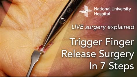 Trigger Finger Surgery
