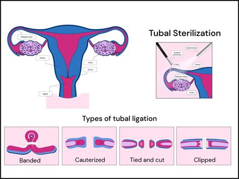Tubal ligation illustration