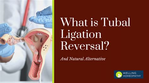 Tubal ligation reversal illustration