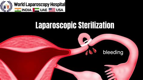 Tubal ligation risks illustration