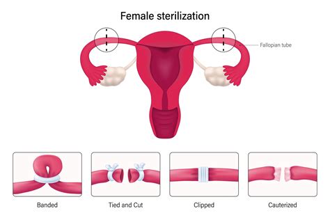 Types of tubal ligation illustration