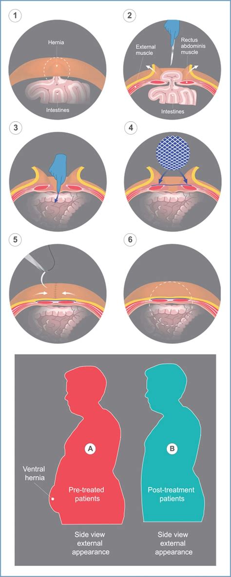 Umbilical Hernia Repair Techniques
