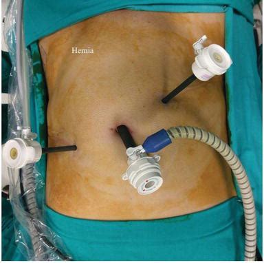 Umbilical Hernia Surgery Preparation