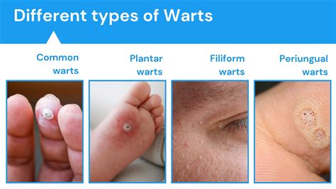 Wart contagion