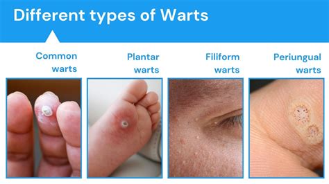 Wart locations