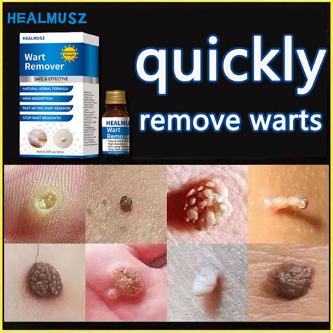 Wart removal